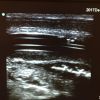 Foreign bodies in genitalia - Time for POCUS!