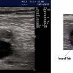 Another reason to use POCUS for Central Lines