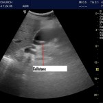 POCUS and recurrent abdominal pain in the elderly