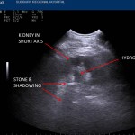 Faster, radiation-free approach to Renal Colic with POCUS/EDE