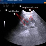 Incidental findings on Renal POCUS