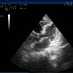 Hypothermic Heart on POCUS