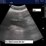 Common Bile Duct Measurements: Not very useful for emergency physicians