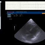 Does the heart REALLY stop when you give Adenosine to an SVT patient – find out with POCUS!
