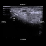 S/Q saline injection for pediatric art lines placed with POCUS guidance?