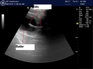 Foley visible in bladder