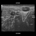 Peripheral IV placement with POCUS