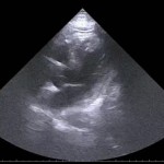 Using POCUS for decision-making in CP R/O ACS cases