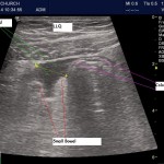 More bowel POCUS: A case of diverticulitis