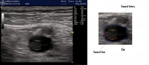 Femoral clot