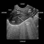 #POCUS for Trauma in pregnancy