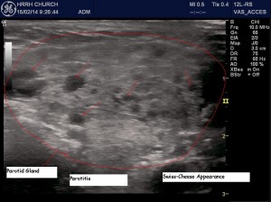 Parotitis