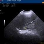 POCUS in Renal Failure