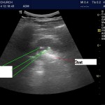 Staghorn Calculus