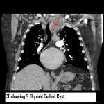 Exploring airway pathology with POCUS