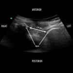 Widened symphysis on POCUS