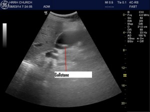 Gallstones