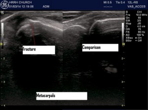 Metacarpal