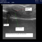 Purulent tenosynovitis on POCUS