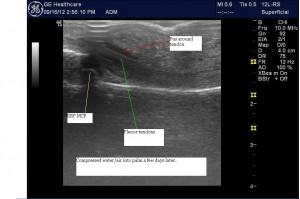 Pustular Tendonitis