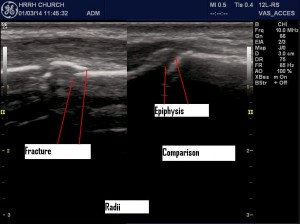 Radius1