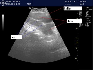 Endometritis