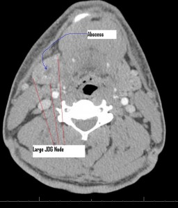 Lymph_CT