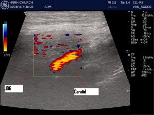 Lymph_Carotid