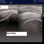 Dislocated? POCUS improves clinical exam