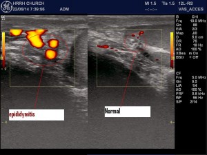 Increased blood flow in epididymus on left.