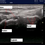 Scaphoid Fracture