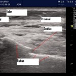 Smith’s Fracture