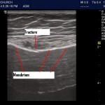 Sternal Fracture