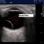 Floaters and Partial Visual Field Loss