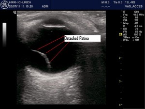 Detached retina
