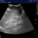 Infectious Mononucleosis? Measure that spleen!