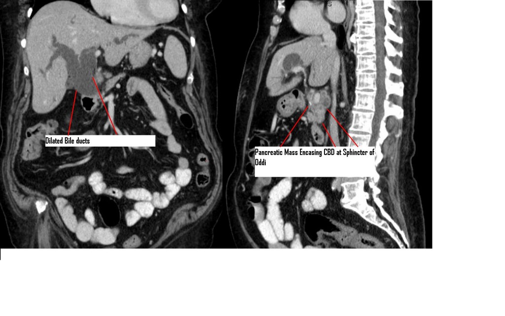 Biliary