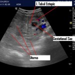 Ectopic & Left FAST