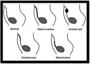 urachal cyst 5