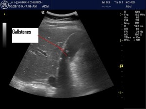 Asymptomatic gallstones