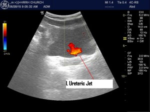 Normal ureteral jet