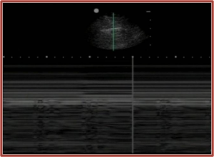 M-mode lung