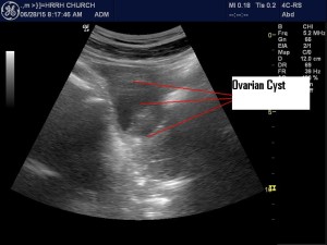 Ovarian Cyst