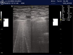 Pulmonary B-lines