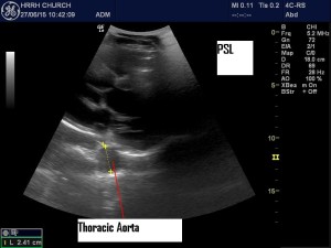 ThorAorta