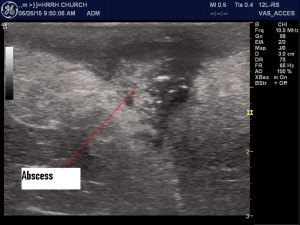 Umbilical Abscess