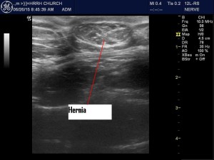 Umbilical hernia