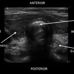 Airway POCUS Article presented by TJ