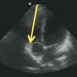 EDE 3: TAPSE for Pulmonary Embolus with Dr. Tom Jelic