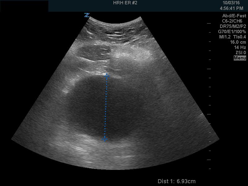 Bladder2